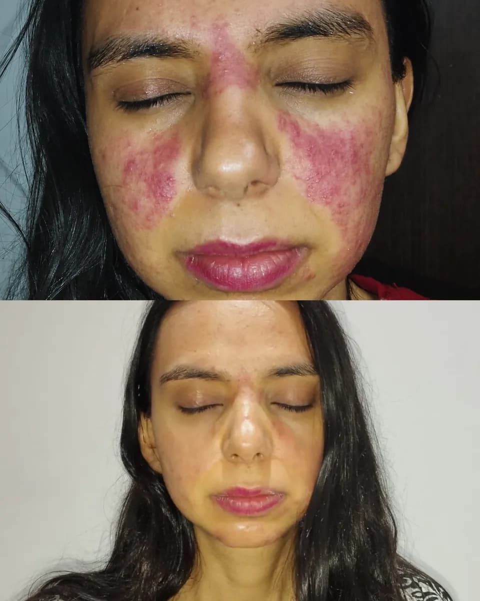 Jessica before and after comparison showing visible facial redness