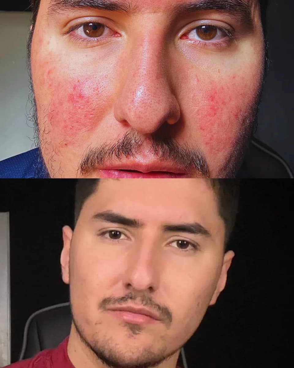 Andrés before and after comparison showing visible cheek redness