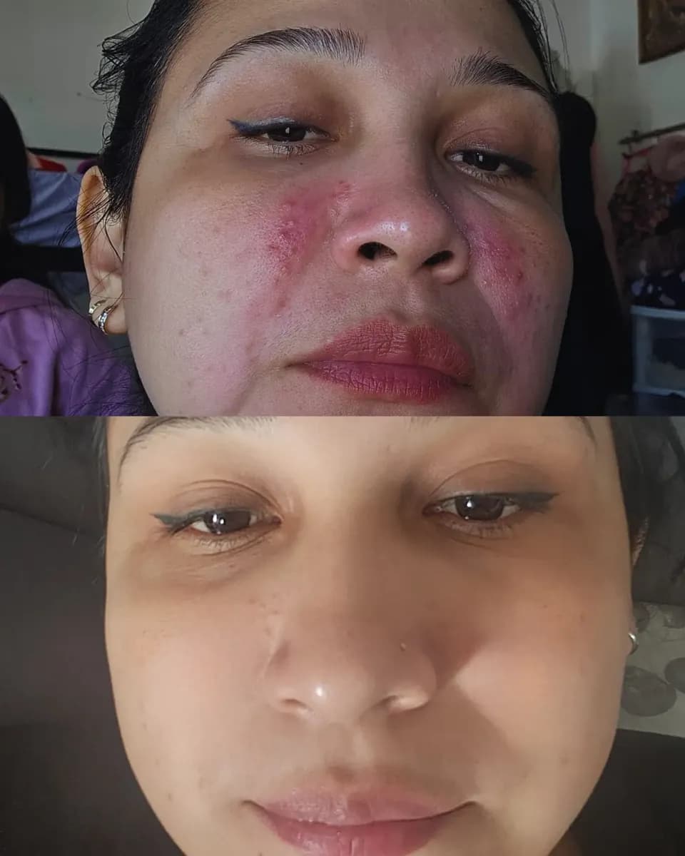 Camila before and after comparison showing visible redness and breakouts