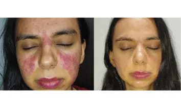 Antes y después real de una piel con rojeces