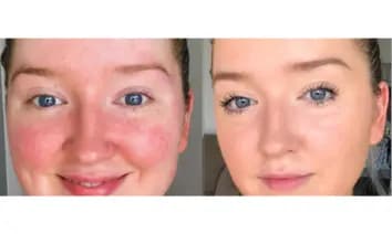 Antes y después real de una piel sensible