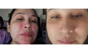 Antes y después real de una piel con textura irregular