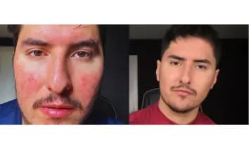 Antes y después real de una piel con sensibilidad visible