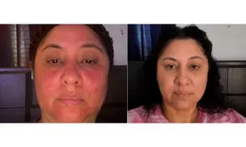 Antes y después real de una piel con rojeces persistentes