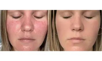 Antes y después real de una piel con barrera alterada