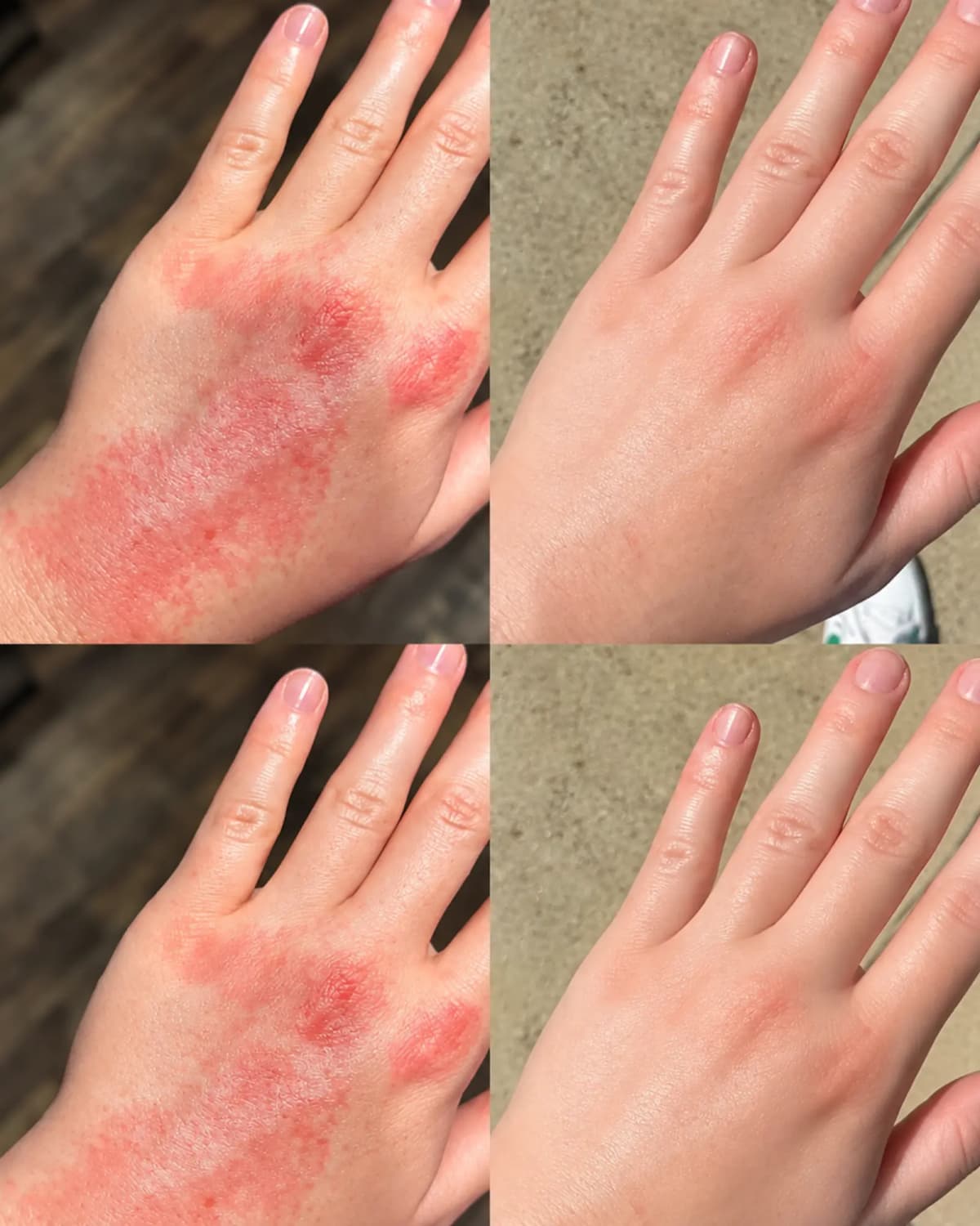Testimonio de una persona con piel con tendencia a dermatitis atópica