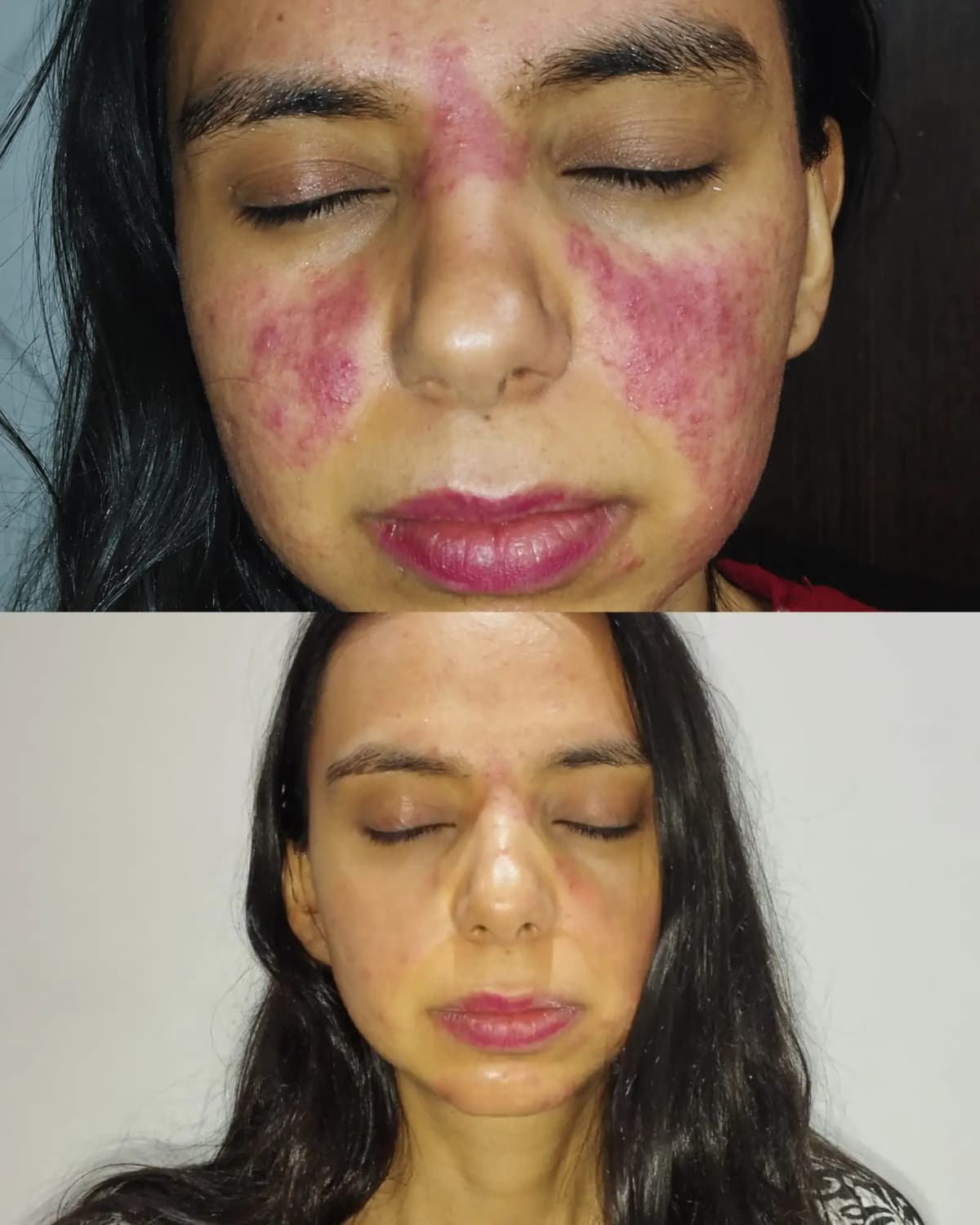 Experiencia real de piel con tendencia a dermatitis 4